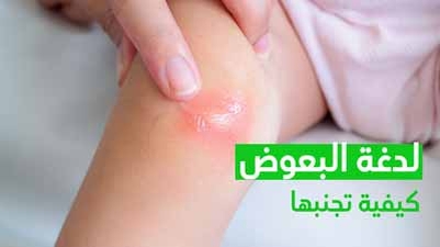 لدغة البعوض كيفية تجنبها