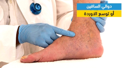 دوالي الساقين أو توسع الدوالي