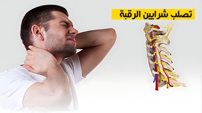 تصلب شرايين الرقبة