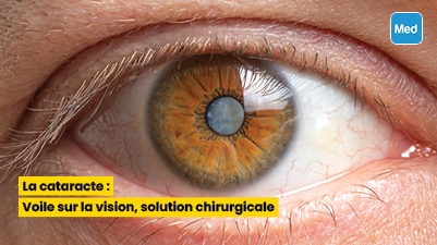 La cataracte : Voile sur la vision, solution chirurgicale